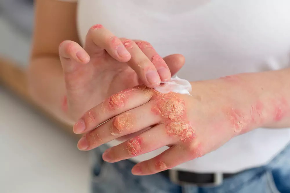 Chronic Skin Diseases